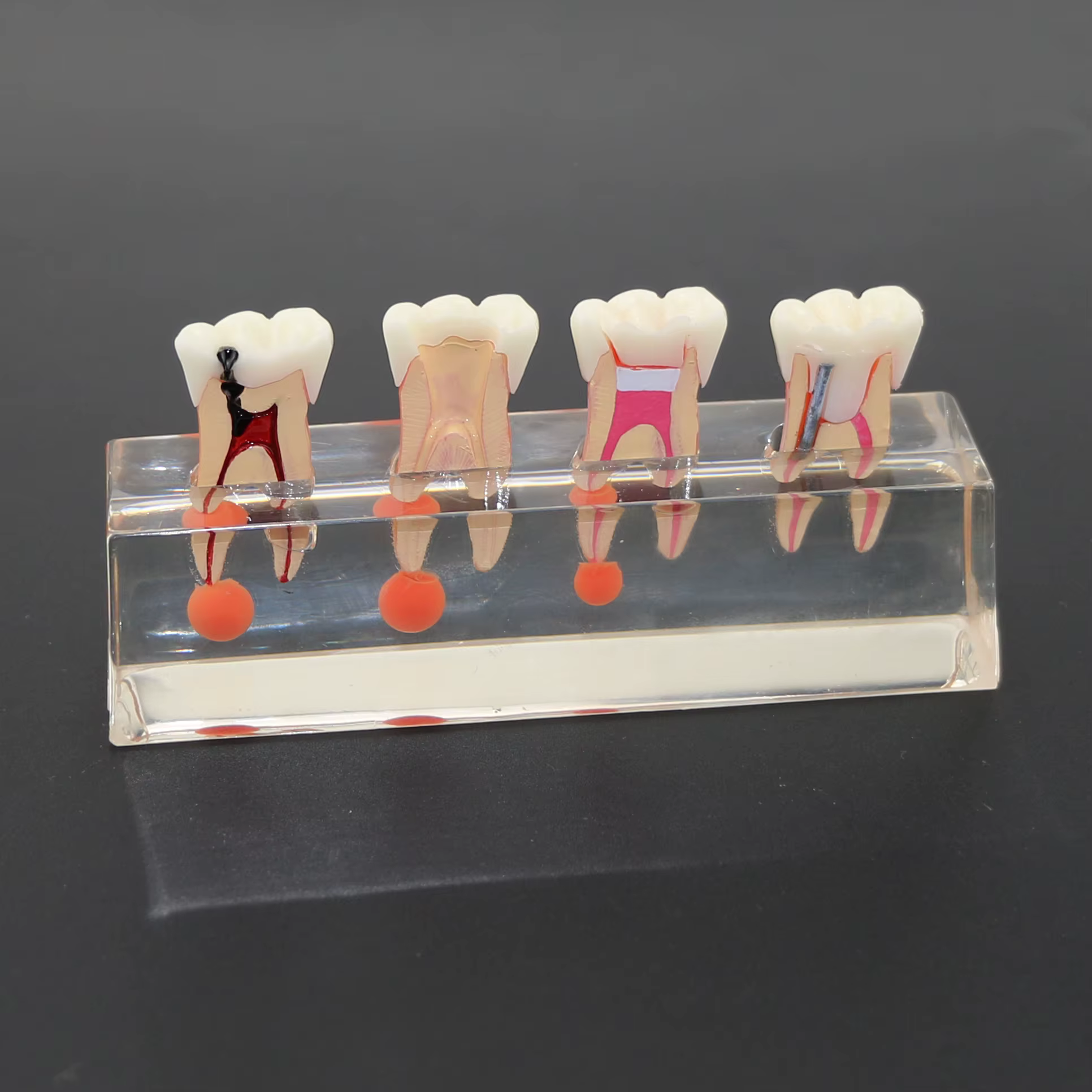 Modèle de dents dentaires transparentes, traitement endodontique en 4 étapes, modèle de démonstratio