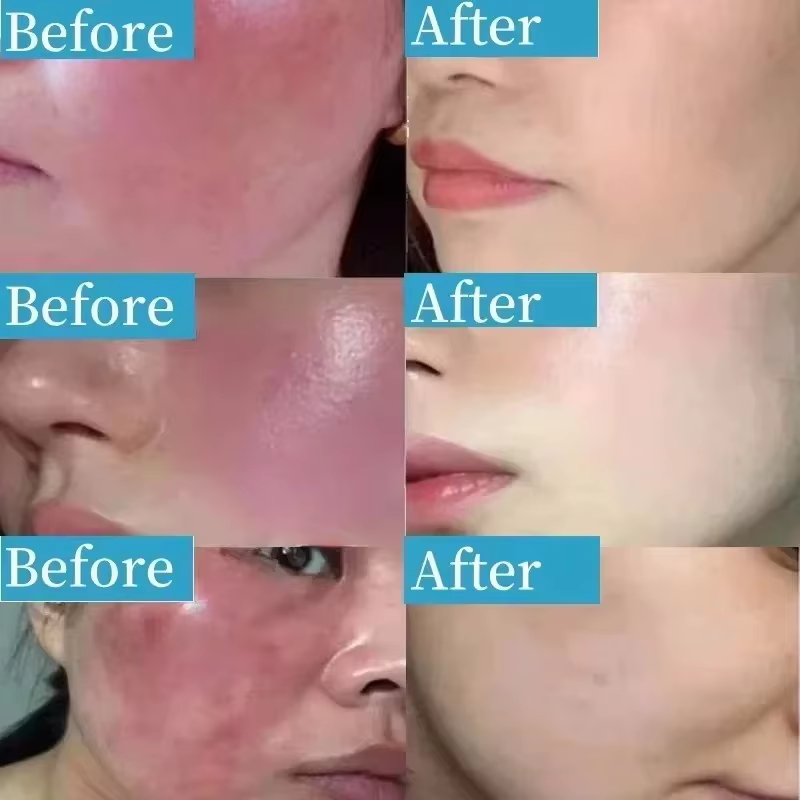 Crème réparatrice des rougeurs du visage coréenne, lotion hydratante et apaisante pour peaux sensibles, rosacée, hydratant jour et nuit pour améliorer la sécheresse