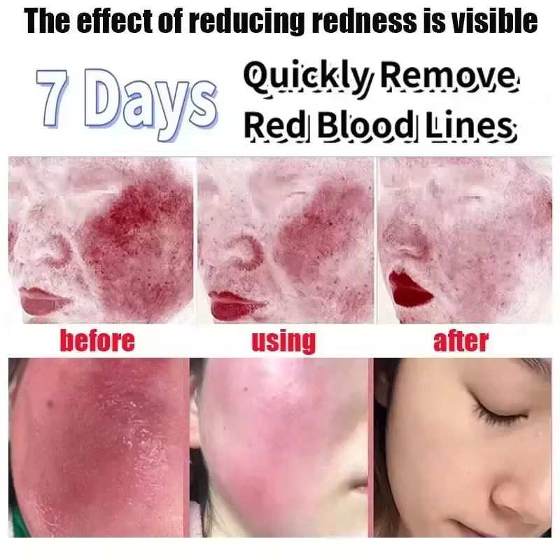 Crème réparatrice des rougeurs du visage coréenne, lotion hydratante et apaisante pour peaux sensibles, rosacée, hydratant jour et nuit pour améliorer la sécheresse