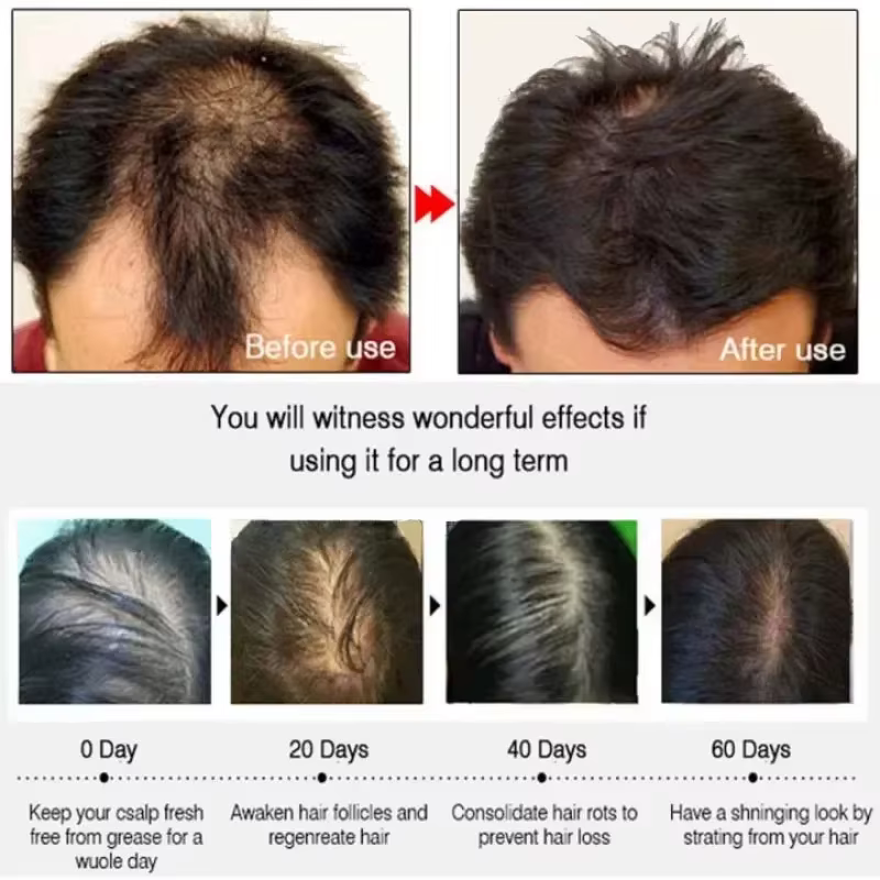 Sérum de croissance des cheveux pour hommes et femmes