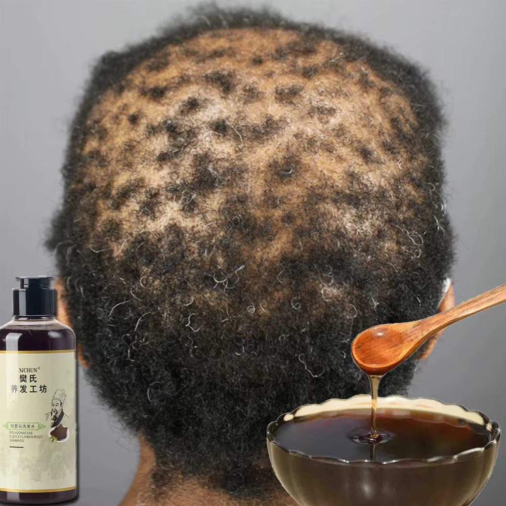 Shampoing Traitant la Chute de Cheveux pour Hommes et Femmes