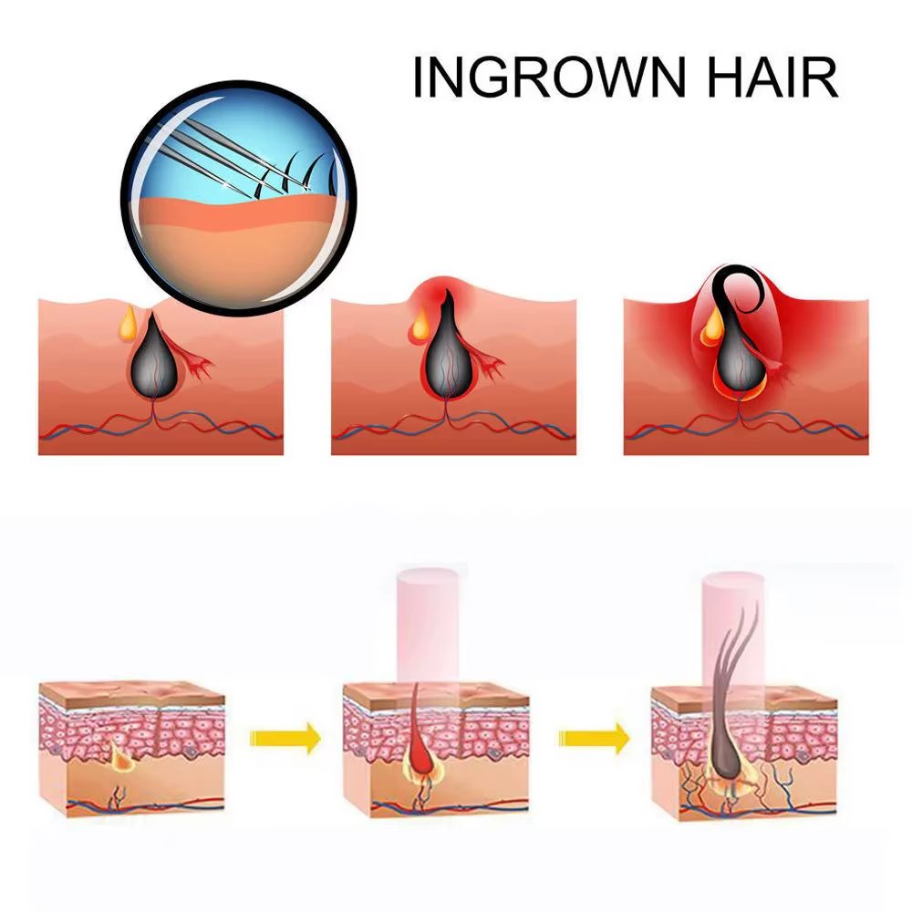 Capuchon de Massage pour thérapie à la lumière rouge LED, pour prévenir la perte de cheveux, utilisé pour le traitement professionnel de la perte de cheveux, réparation de la croissance sèche