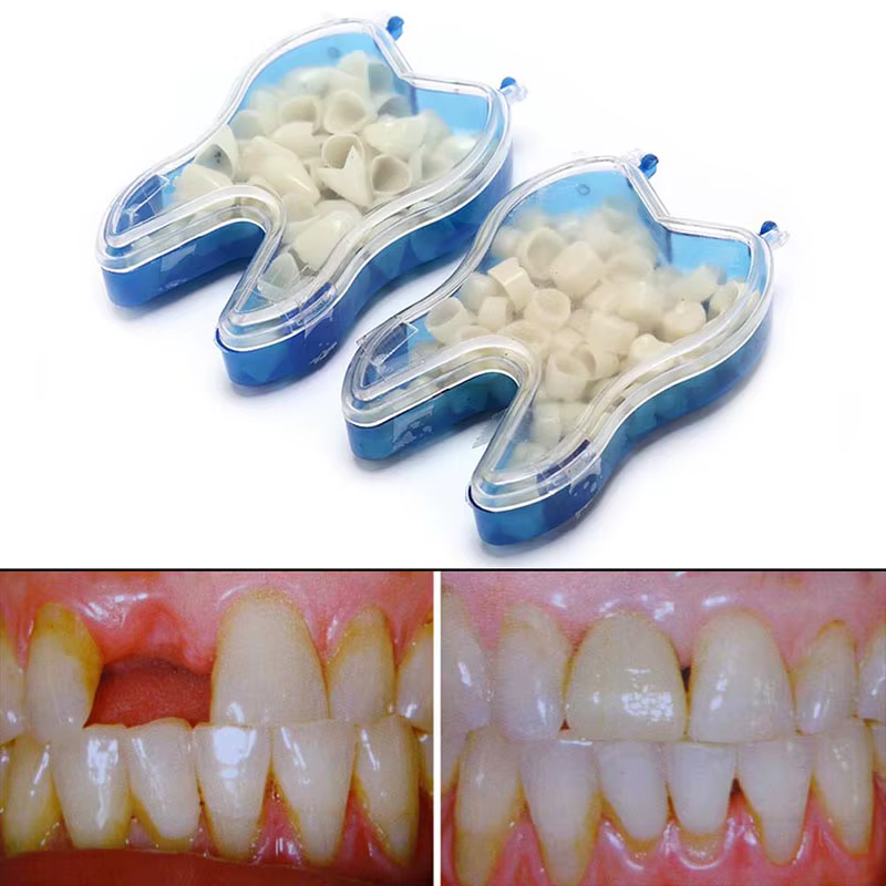 Kit de couronne dentaire temporaire, 50 pièces/boîte, placage de dents antérieures, molaire avant, postérieur, soins buccaux, blanchiment des dents, matériel de dentiste